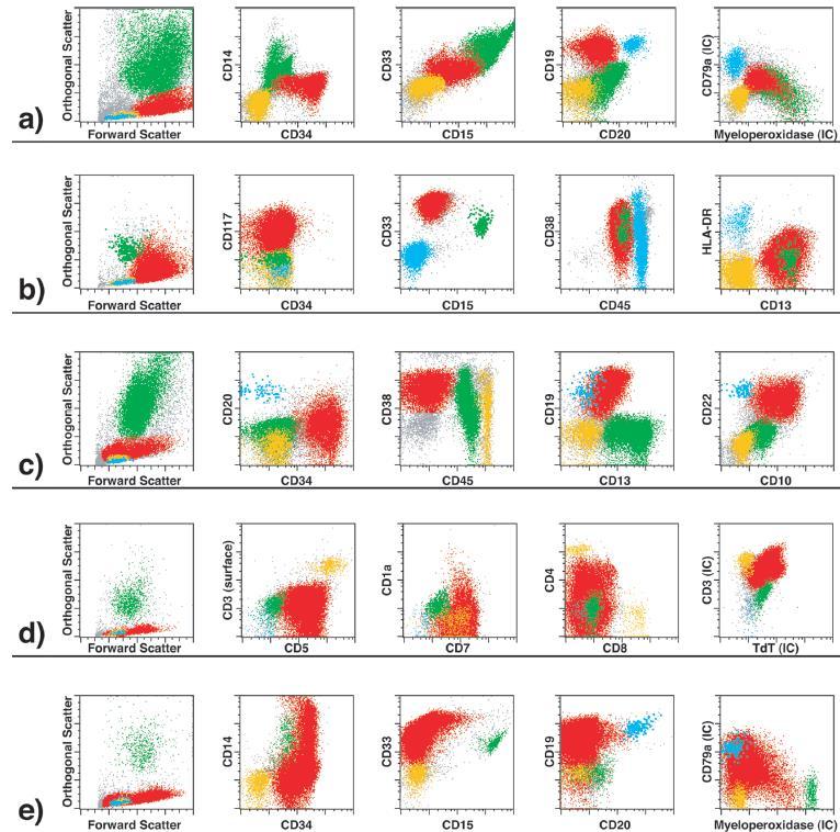 a, Acute myeloid leukemia with expression of CD34, CD15, CD33, and myeloperoxidase. These features suggest a possible recurrent t(8;21)(q22;q22), which was later confirmed by cytogenetic analysis.