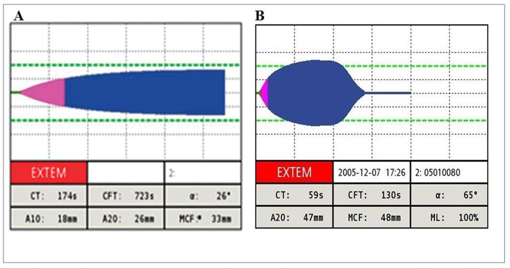 Typical curves in severe trauma