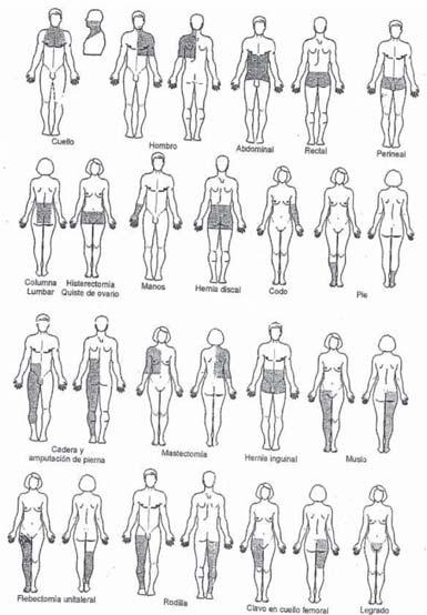 Puntos críticos 17,32,34,37,39,69-71 : Es importante la realización de un correcto lavado o baño previo del paciente.