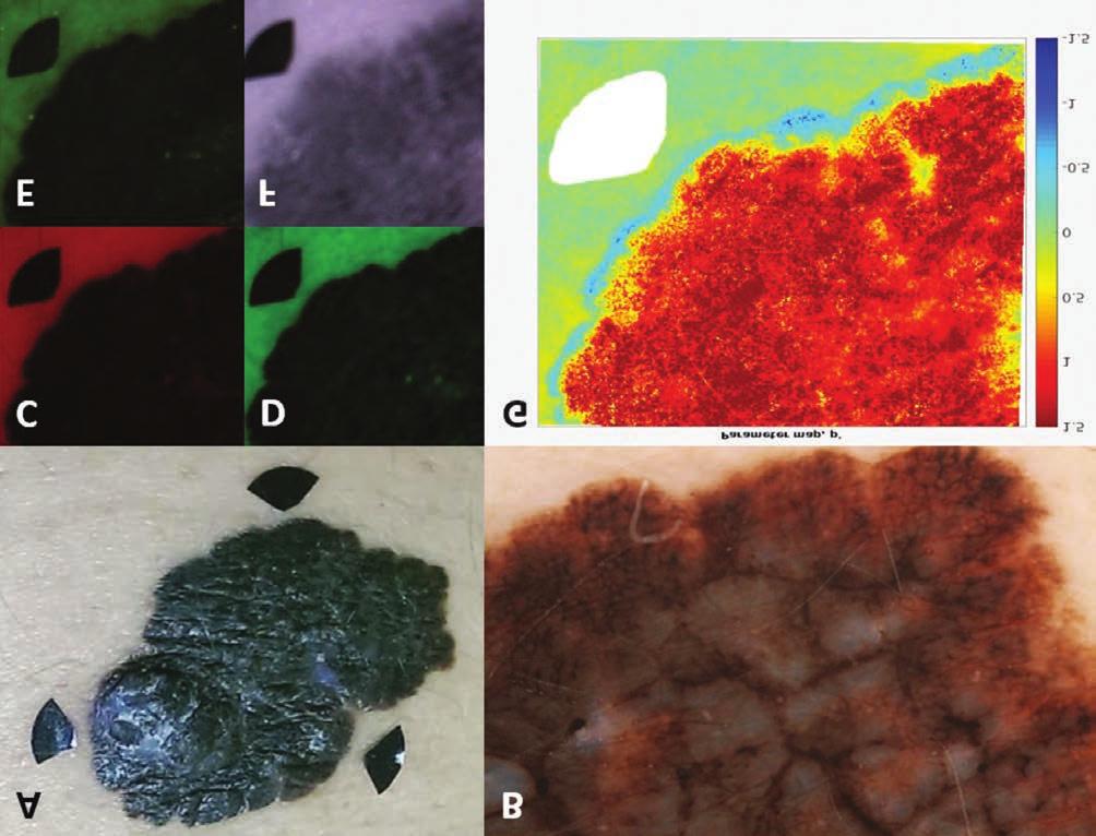 2. ábra Melanoma malignum RGB autofluorszcencia (RGB-AF) vizsgálata. A: klinikai fénykép, a lézióra irányuló fekete nyilak a képalkotást segítik.