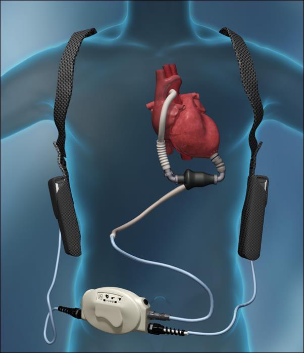 Folyamatos áramlású hosszú távú LVAD Közös tulajdonságok: Mellkason belüli Driveline szükséges HM 2+3, HW: hasfali Jarvik: retroaurikuláris