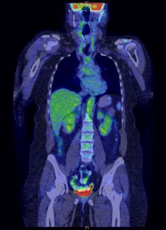6. PET CT Indikáció: tünet orientált nagyér vasculitis susp. aorta teljes hossza, illetve az a.