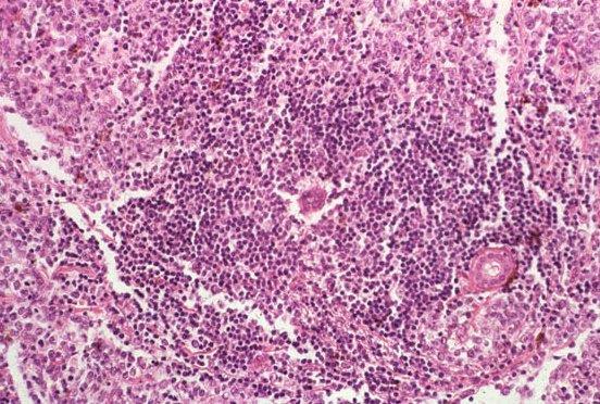 BIOPSIA 2. Nyálmirigy Indikáció: Sjögern sy susp. Karakterisztikus jelek: 50 vagy több ly cluster, lobulusonként legalább 4 31 BIOPSIA 3.