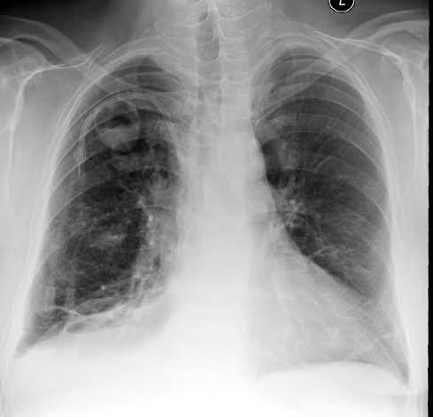 fibrosis shrinking lung kis tüdőtérf.
