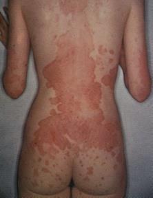 Psoriasis