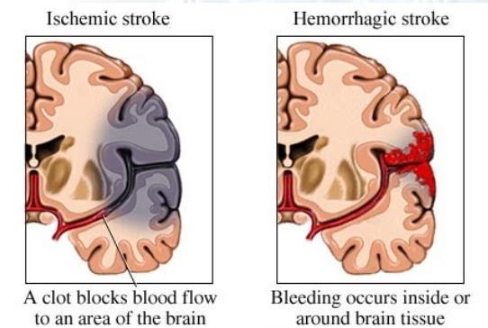 Motoros tünetek: a legfontosabb és leggyakoribb jelenségek STROKE Transient ischemic attack (TIA): a tünetek 24 órán belül megszűnnek Ischemiás stroke Haemorrhagiás stroke 85% 15%