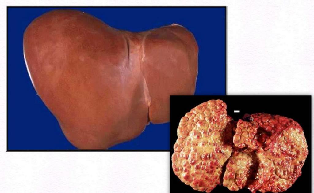 Cirrhosis A cirrhosis a máj???????megbetegedése, amire a szerv egészének állebenykés átépülése és hegesedése jellemző.