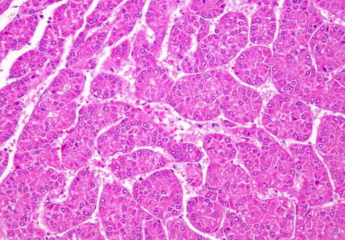 cirrhosis, Aflatoxin NAFLD-cirrhosis AAT hiány Hemochromatosis