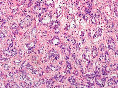 -Cholangiolaris típus -IDH1 mutation (p.