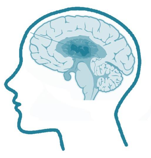 Bevezetés glióma, glioblastoma multiforme (GBM): az agyban, gerincvelőben található gliasejtek (támasztósejtek) tumoros elváltozása várható túlélés alacsony (~1,5 év) tumor őssejtek: tumor kiújulása,