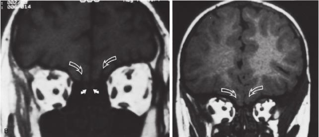 Normális sulcus olfactorius és bulbus olfactorius