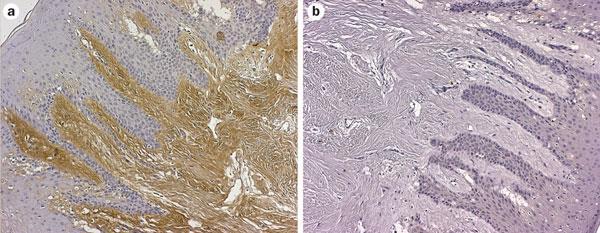 Citrullinated proteins are present in the gingiva of a patient with periodontitis Lundberg, K. et al.