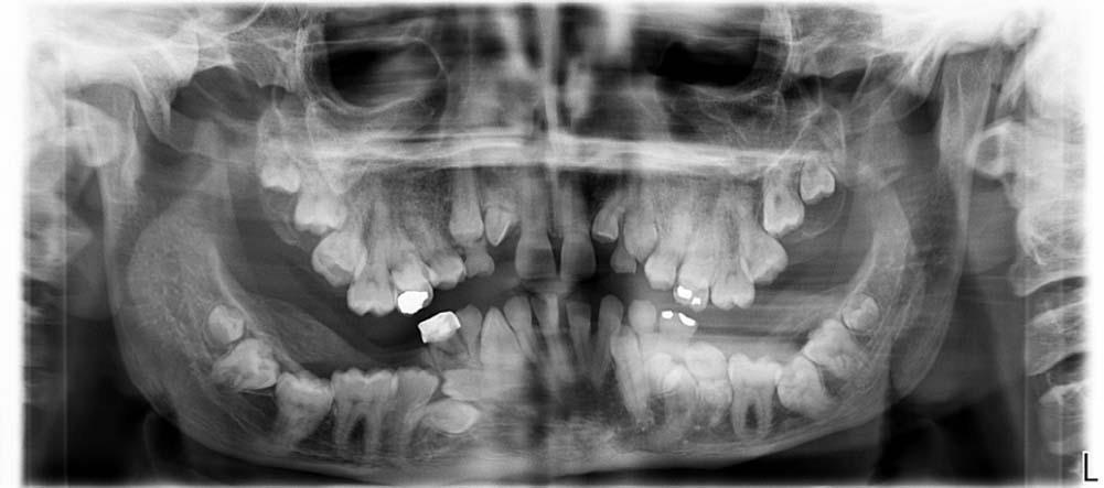 HYPERDONTIA Zavar: a fogfejlődés iniciációs és proliferációs fázisában Tejfogazat prevalencia: 0,3-0,6% Ha klinikailag nem indokolt az extrakció - nem igényel kezelést Általában a maradófogazatban in