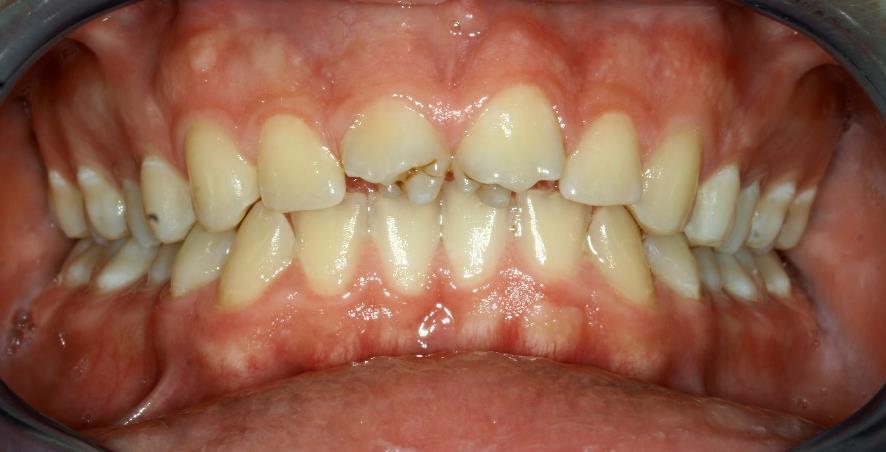 HYPERDONTIA - CLASSIFICATION Megjelenés Dens supernumerarius atípusos anatómia Általában kisebbek