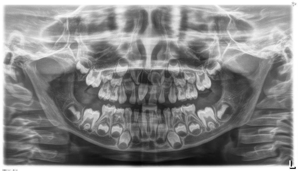 HYPERDONTIA - CLASSIFICATION Lokalizáció 1.