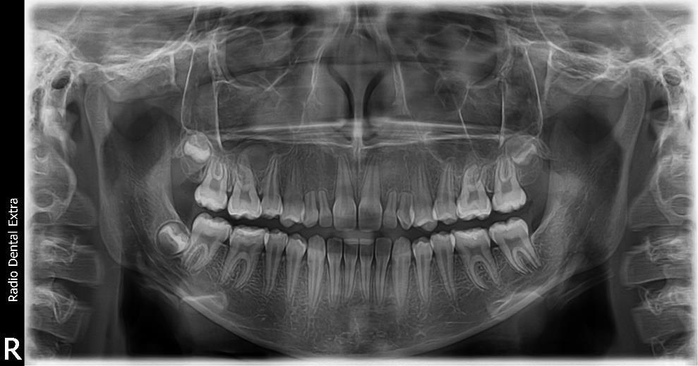 HYPODONTIA, APLASIA Zavar: a fogfejlődés iniciációs és proliferációs fázisában Anodontia - a fogak teljes hiánya, extrém forma Oligodontia több fog veleszületett hiánya általában ED-hoz társul