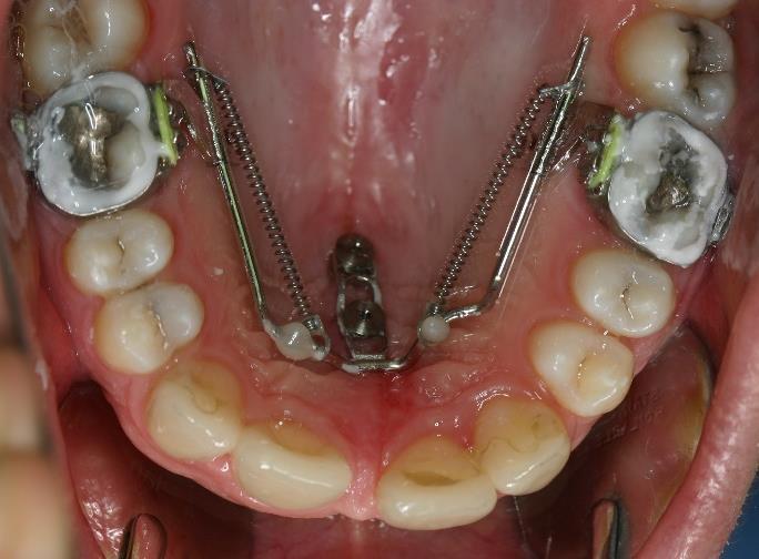 HYPODONTIA, APLASIA - HIÁNYZÓ FELSŐ KISMETSZŐK Kezelési alternatívák részárás,