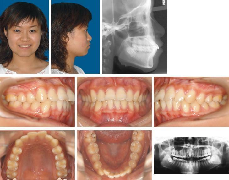 HARAPÁSI ELTÉRÉSEK VS FOGSZABÁLYOZÁSI ÁLLAPOTOK Malocclusion - ideális harapástól bármilyen eltérés Orthodontiai állapotok (National Academy of Sciences) Normocclusio mellett olyan fogazati eltérés