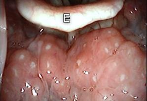 Tonsillitis lingualis igen komoly nyelési panaszok, idegentest érzés, nyelv mozgási fájdalma, áll alatti nyirokcsomók duzzanata gyakoribb