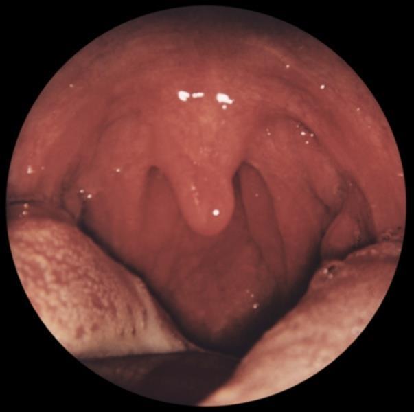 Pharyngitis lateralis a lateralis garatkötegek vérbővek, duzzadtak, pontszerű sárgás lepedékkel fedettek enyhébb nyelési