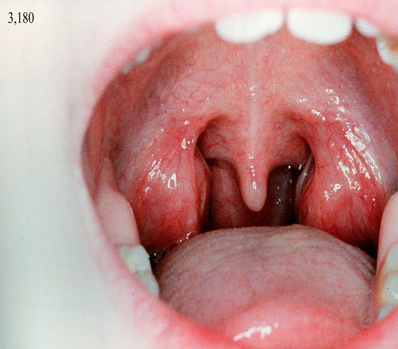 Tonsillitis chronica Lokális lelet: - mellső garatív hiperamiás szegélye - tonsillákból sárgás váladék exprimálható a detritus nem kórjelző!