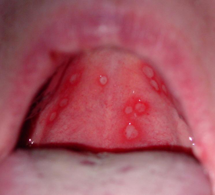 Herpes simplex vírus Herpes simplex 90 % vírushordozó, 1%: herpes labialis vagy stomatitis herpetiformis égő fájdalom, foetor ex ore, nyirokcsomó duzzanat,