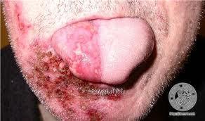 Herpes zoster neurotrop herpes zoster varicellae vírus égő fájdalom, elesettség, táplálkozási elégtelenség csoportosan jelentkező, confluálódó,