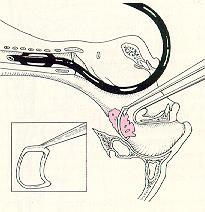 Terápia adenotomia