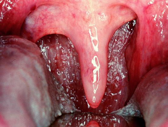 Bakteriális - rendszerint vírusos fertőzés bakteriális felülfertőződése, ritkábban primer bakteriális fertőzés Streptococcus pyogenes (A csop. béta haem.