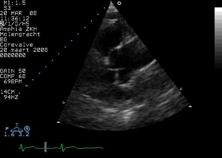 (szív + aorta) sinus