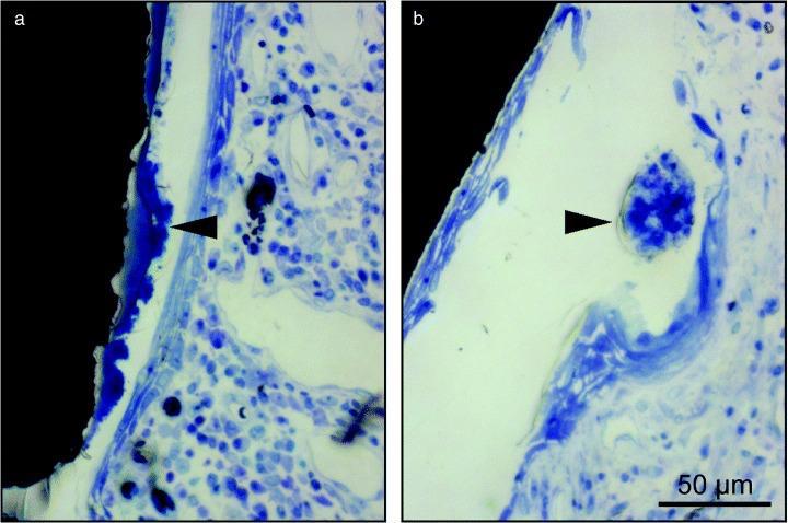 Patogenezis Mucositis hasonló a gingivitishez Peri-implantitis különbözhet a parodontitistől súlyosság és sejtösszetétel tekintetében Neutrophil granulocyták és macrophagok nagyobb számban Apicalis