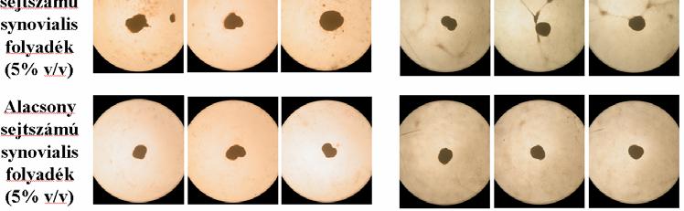 Rheumatoid arthritises betegek synovialis folyadékának hatása az in vitro porcnövekedésre A képeken jól látható, hogy a gyulladás folyamatokra jellemző magas sejtszámú (14,8 G/l) synovialis folyadék