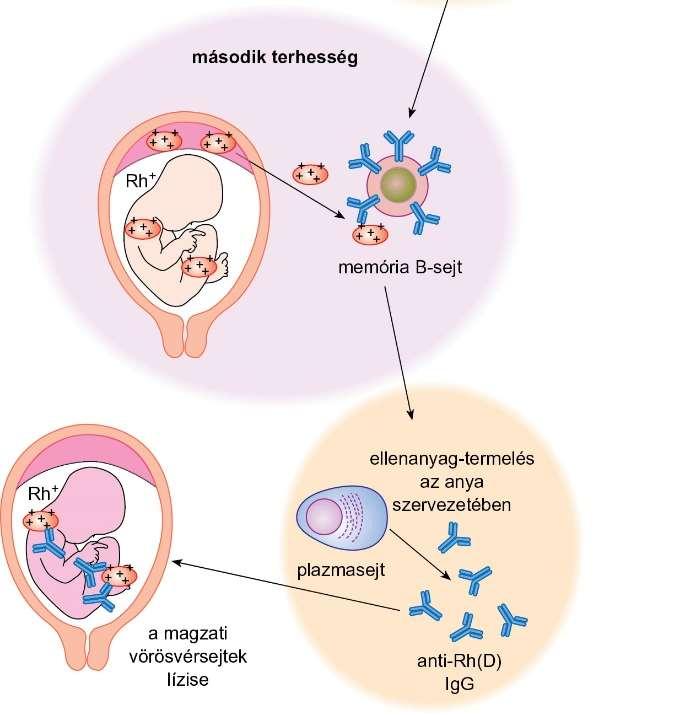 18.9. ábra Újszülöttek hemolitikus betegségének kialakulása (Rh-