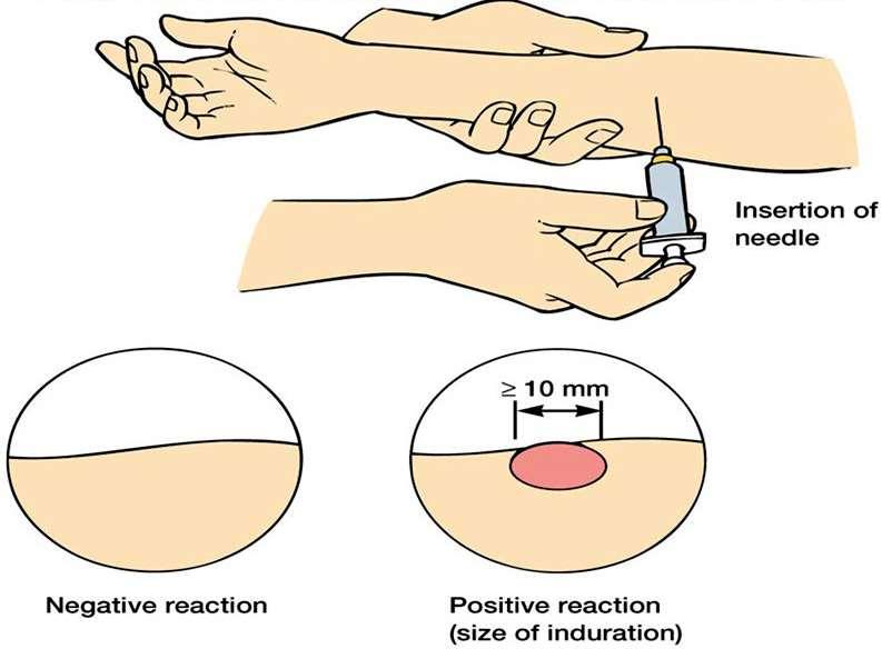 Tuberkulin / Mantoux próba (BCG-fertőzést mutat ki) Tű beszúrása Ag bevitele