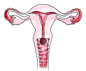 MI TÖRTÉNIK A HPV-FERTÕZÉS SORÁN? A méhnyak (nevezik méhszájnak is) a méh alsó része, a hüvely felett található. Ez a HPV kedvenc közege.