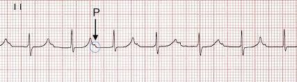 I. fokú AV-blokk Felületi EKG-n P-Q hosszabb 200 msec-nál