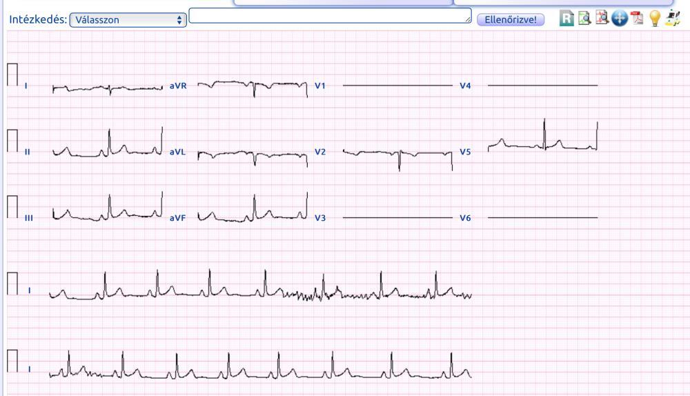 3. Holter, EKG távmonitorozás 1. Holter: A beteg szívritmusa hosszabb ideig megfigyelhető, 24 óra-1 hét A beteg tudja jelezni panaszát Hátránya : kényelmetlen, limitált idő 2.