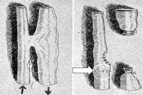 DR. BARTOS GÁBOR ÉS MTSAI. 59. ábra. Poplitealis, sérüléses arterio-venosus fistula és műtéti megoldása álaneurysmát észleltek.