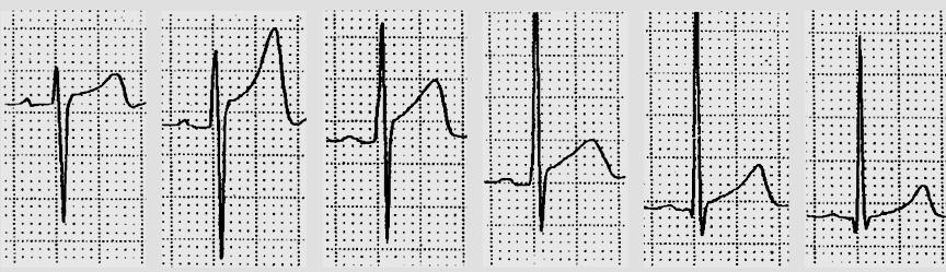 Normál l EKG férfi jelleg V1 V2 V3 V4 V5 V6 n=6014 16-58 év közötti egészséges ffi 91%-ának 1-3 mm közötti STe volt egy vagy több precordalis elvezetésben (max V2) n=529 17-24 éves ffi normál