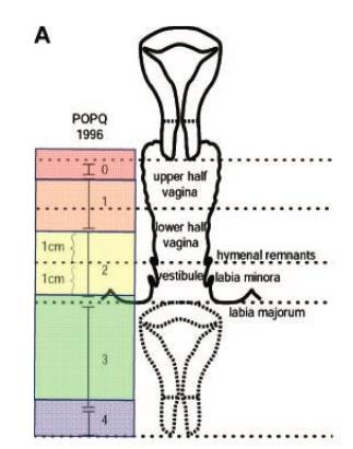 POP - JELEK Pelvic organ prolapse