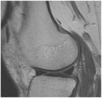 Nagyobb FOV mellett STIR PDFS helyett Rheumatológia,