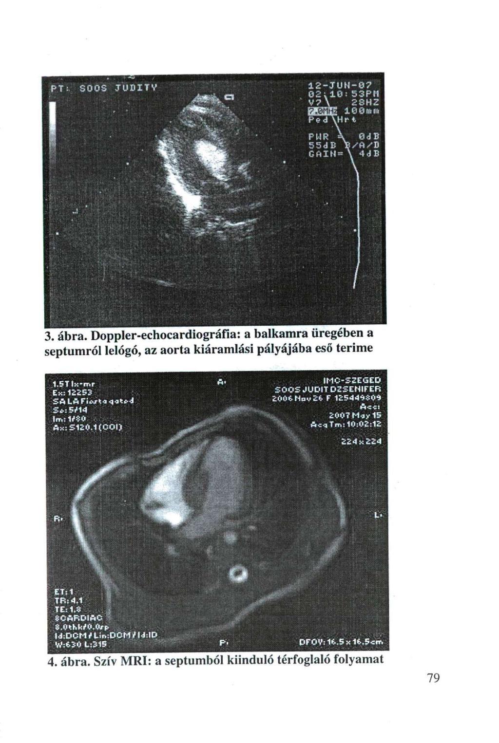 12-7UN-0? : 53PN 2SHZ íeorrtm r t PMR 55d B CftIN = 0d B 4d B septumról lelógó, az aorta kiáramlási palyajaba eso t e n n i e 1.