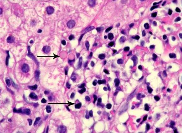 Akut és krónikus hepatitisek Autoimmun hepatitis az autoimmun hepatitis a hepatitisek egy speciális formája -Gyakrabban fordul elő