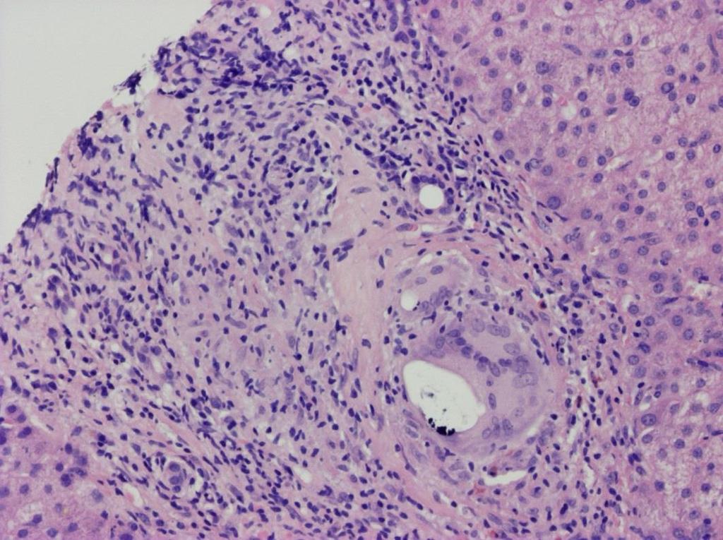 Cholestaticus májbetegségek (PBC,PSC) PBC PRIMER BILIARIS CIRRHOSIS- Primary biliary cholangitis a kis- közepes méretű epeutak destrukciója, AMA+, középkorú nők, gyakran tárul egyéb autoimmun