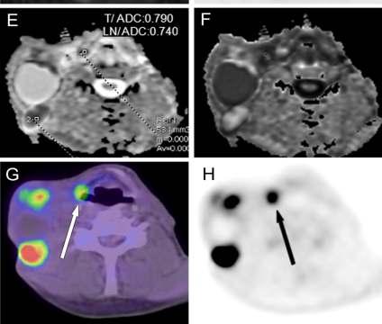 74 x10-3 mm 2 /s, e-adc Hisztológia: laphámcarcinoma, T1N3M0 FDG-PET/CT FDG-PET Gődény M, Lengyel Zs, Polony G,