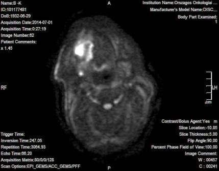KTH után: reziduális ca 3 T - MP-MRI: anatómiai +