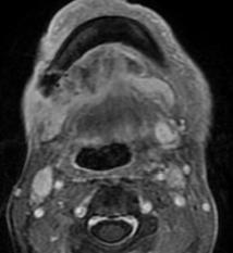 Boer A, Javor L, Gődény M, Dynamic Contrast-Enhanced MRI Parameters as Biomarkers in Assessing Head