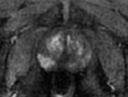 EmelkedőPSA -MP-MRI PI-RADS V2 score 5 (perifériás zóna) score