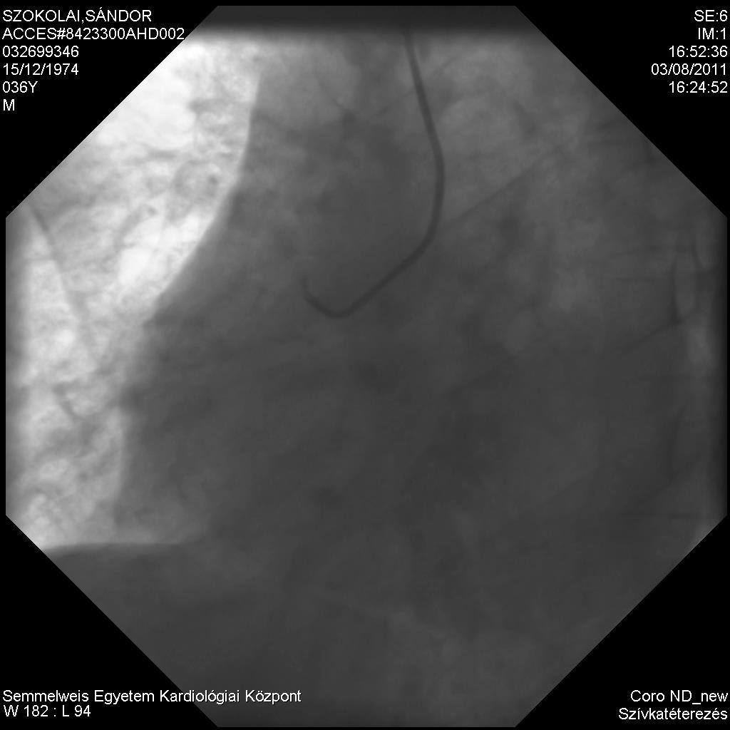 Jobb coronária Szív CT angiográfia