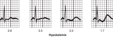 2018 EKG lapos T, ST depresszió, U-hullám, U>T, TU összeolvadás